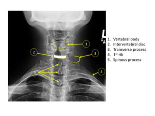 L1-vertebra Radiological -Anatomy. pptt | PPT