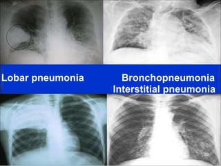 Lobar pneumonia Bronchopneumonia
Interstitial pneumonia
25
 