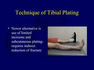 Technique of Tibial Plating
• Newer alternative is
use of limited
incisions and
subcutaneous plating-
requires indirect
reduction of fracture
 