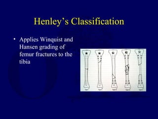 Henley’s Classification
• Applies Winquist and
Hansen grading of
femur fractures to the
tibia
 