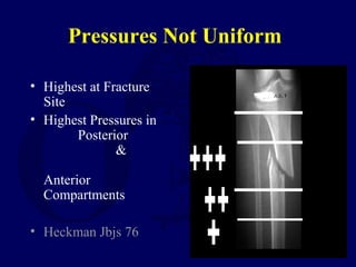 Pressures Not Uniform
• Highest at Fracture
Site
• Highest Pressures in
Posterior
&
Anterior
Compartments
• Heckman Jbjs 76
 