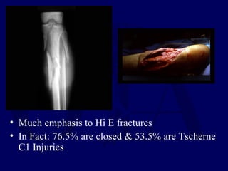 • Much emphasis to Hi E fractures
• In Fact: 76.5% are closed & 53.5% are Tscherne
C1 Injuries
 