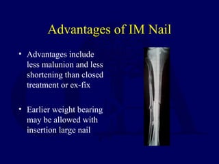 Advantages of IM Nail
• Advantages include
less malunion and less
shortening than closed
treatment or ex-fix
• Earlier weight bearing
may be allowed with
insertion large nail
 