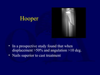 Hooper
• In a prospective study found that when
displacement >50% and angulation >10 deg.
• Nails superior to cast treatment
 