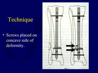 Technique
• Screws placed on
concave side of
deformity.
 