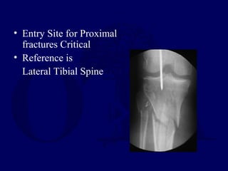 • Entry Site for Proximal
fractures Critical
• Reference is
Lateral Tibial Spine
 
