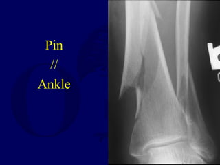 Pin
//
Ankle
 