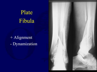 Plate
Fibula
+ Alignment
- Dynamization
 