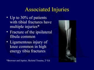 Associated Injuries
• Up to 30% of patients
with tibial fractures have
multiple injuries*
• Fracture of the ipsilateral
fibula common
• Ligamentous injury of
knee common in high
energy tibia fractures
*Browner and Jupiter, Skeletal Trauma, 2nd
Ed
 