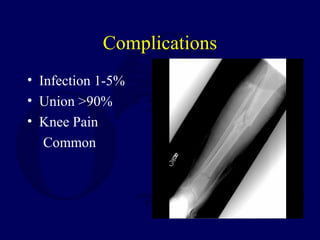 Complications
• Infection 1-5%
• Union >90%
• Knee Pain
Common
 