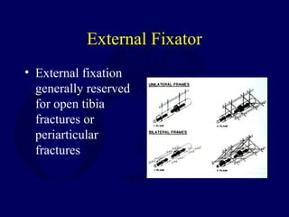 External Fixator
• External fixation
generally reserved
for open tibia
fractures or
periarticular
fractures
 