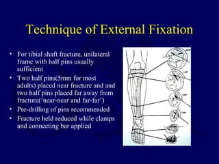 Technique of External Fixation
• For tibial shaft fracture, unilateral
frame with half pins usually
sufficient
• Two half pins(5mm for most
adults) placed near fracture and and
two half pins placed far away from
fracture(‘near-near and far-far’)
• Pre-drilling of pins recommended
• Fracture held reduced while clamps
and connecting bar applied
 