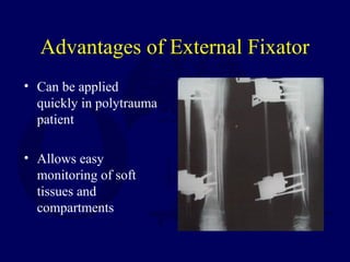 Advantages of External Fixator
• Can be applied
quickly in polytrauma
patient
• Allows easy
monitoring of soft
tissues and
compartments
 