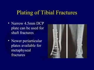 Plating of Tibial Fractures
• Narrow 4.5mm DCP
plate can be used for
shaft fractures
• Newer periarticular
plates available for
metaphyseal
fractures
 