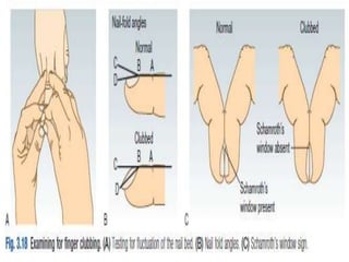 Nail Clubbing Algorithm L 11 12 .Approach to edema & clubbing | PPTX