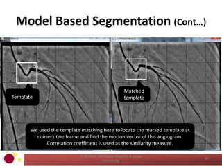 Model Based Segmentation (Cont…)
COM 2304 - Computer Graphics & Image
Processing
30
Template
Matched
template
We used the template matching here to locate the marked template at
consecutive frame and find the motion vector of this angiogram.
Correlation coefficient is used as the similarity measure.
 
