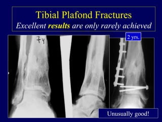 Tibial Plafond Fractures
Excellent results are only rarely achieved
2 yrs.
Unusually good!
 
