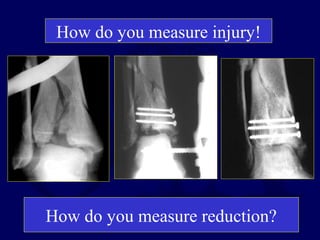 How do you measure reduction?
How do you measure injury!
 
