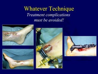 Whatever Technique
Treatment complications
must be avoided!
 