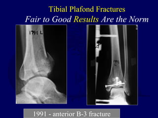Tibial Plafond Fractures
Fair to Good Results Are the Norm
1991 - anterior B-3 fracture
 