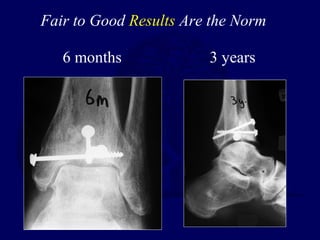 6 months 3 years
Fair to Good Results Are the Norm
 