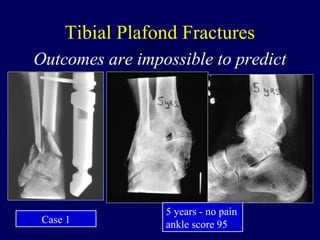Tibial Plafond Fractures
Outcomes are impossible to predict
5 years - no pain
ankle score 95Case 1
 