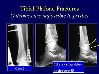 Tibial Plafond Fractures
Outcomes are impossible to predict
6.5 yrs - miserable -
ankle score 45
Case 2
 