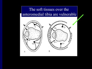 The soft tissues over the
anteromedial tibia are vulnerable
 