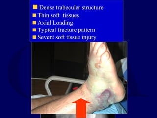 Dense trabecular structure
Thin soft tissues
Axial Loading
Typical fracture pattern
Severe soft tissue injury
 
