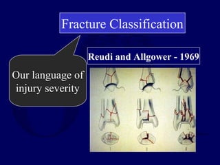 Fracture Classification
Our language of
injury severity
Reudi and Allgower - 1969
 