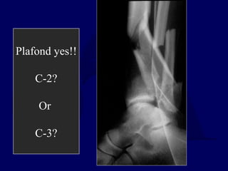 Plafond yes!!
C-2?
Or
C-3?
 