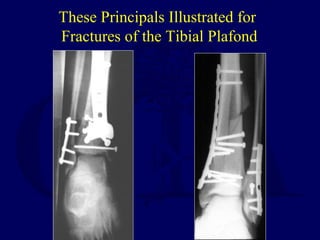 These Principals Illustrated for
Fractures of the Tibial Plafond
 