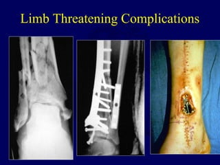 Limb Threatening Complications
 
