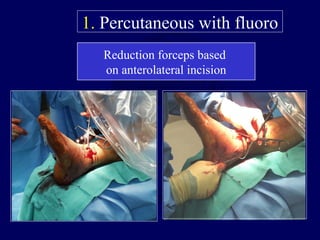 Reduction forceps based
on anterolateral incision
1. Percutaneous with fluoro
 