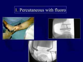 1. Percutaneous with fluoro
 