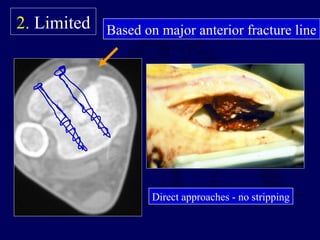 Based on major anterior fracture line
Direct approaches - no stripping
2. Limited
 