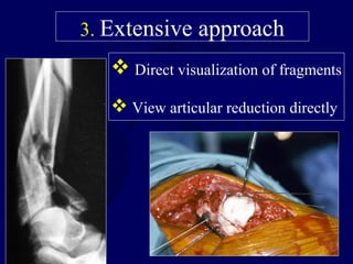 3. Extensive approach
 Direct visualization of fragments
 View articular reduction directly
 