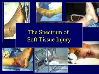 The Spectrum of
Soft Tissue Injury
 