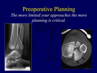 Preoperative Planning
The more limited your approaches the more
planning is critical.
 