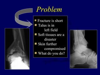 Problem
Fracture is short
Talus is in
left field
Soft tissues are a
disaster
Skin further
compromised
What do you do?
 