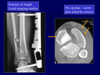 Pre op plan – screw
plan noted by arrows
Fracture at length
Good imaging studies
 