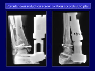 Percutaneous reduction screw fixation according to plan
 