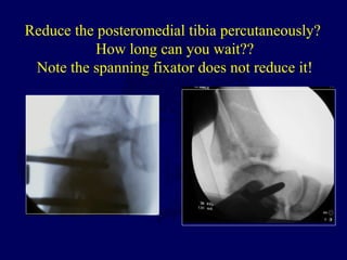 Reduce the posteromedial tibia percutaneously?
How long can you wait??
Note the spanning fixator does not reduce it!
 