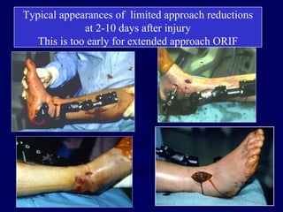Typical appearances of limited approach reductions
at 2-10 days after injury
This is too early for extended approach ORIF
 