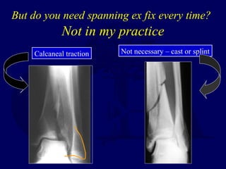 But do you need spanning ex fix every time?
Not in my practice
Not necessary – cast or splintCalcaneal traction
 