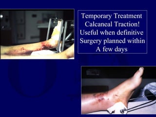 Temporary Treatment
Calcaneal Traction!
Useful when definitive
Surgery planned within
A few days
 