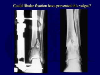Could fibular fixation have prevented this valgus?
 