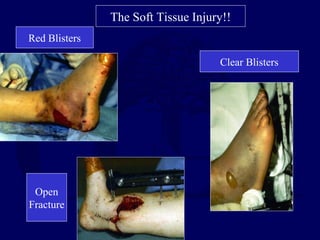 The Soft Tissue Injury!!
Red Blisters
Clear Blisters
Open
Fracture
 