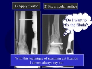 1) Apply fixator 2) Fix articular surface
Do I want to
fix the fibula?
Do I want to
fix the fibula?
With this technique of spanning ext fixation
I almost always say no!
 