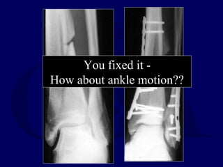 You fixed it -
How about ankle motion??
 